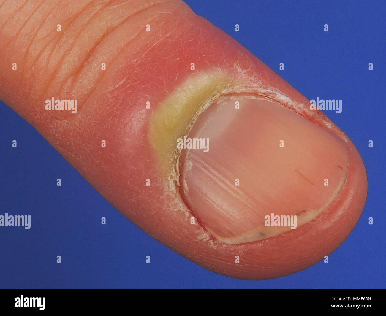 Onychia hi-res stock photography and images - Alamy