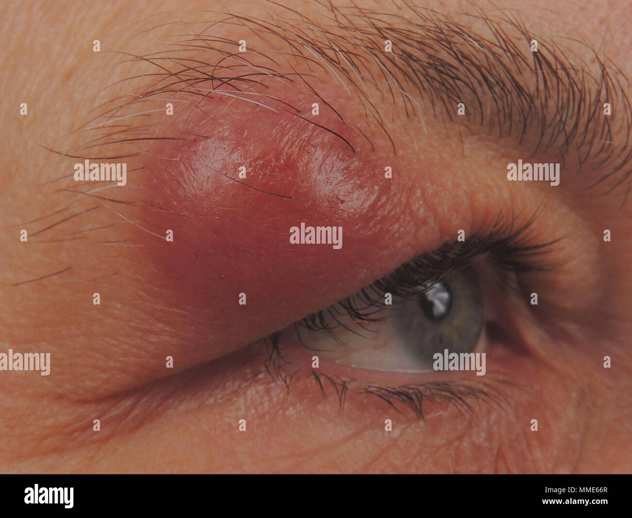 Sebaceous cyst hires stock photography and images Alamy