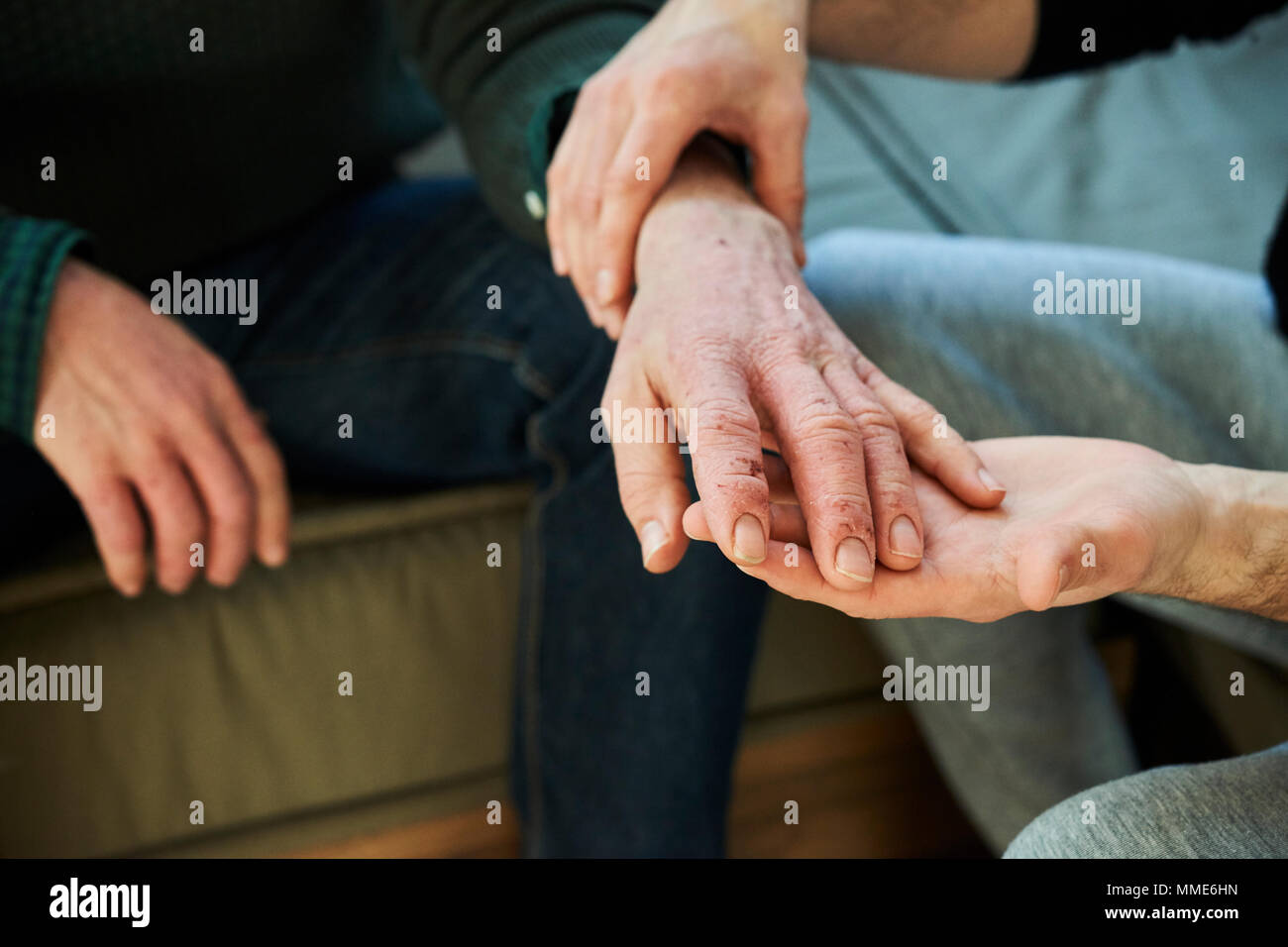 DYSHIDROSIS Stock Photo