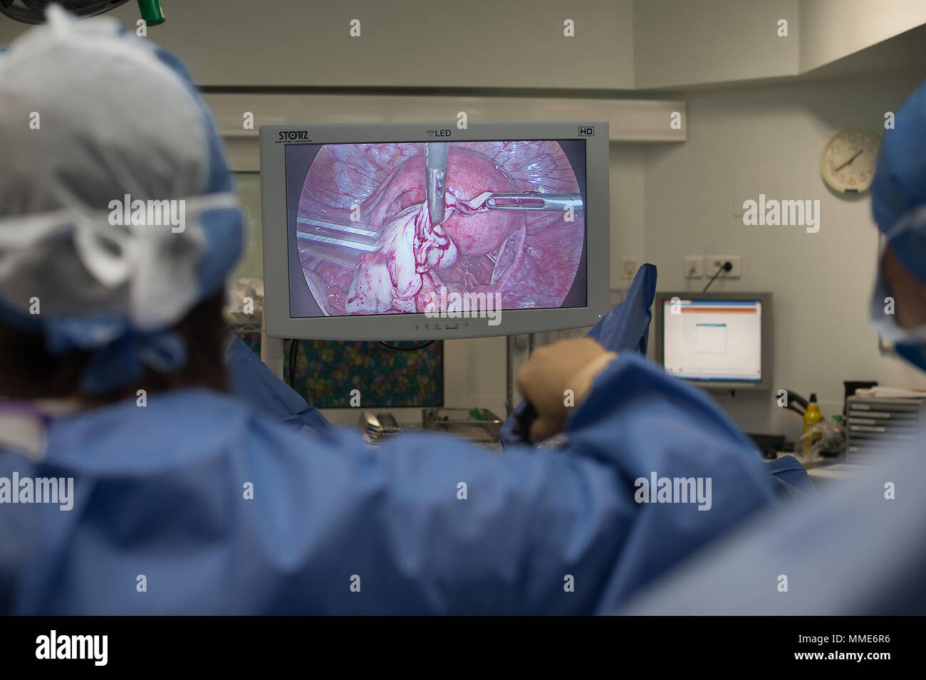 ENDOMETRIOSIS SURGERY Stock Photo - Alamy