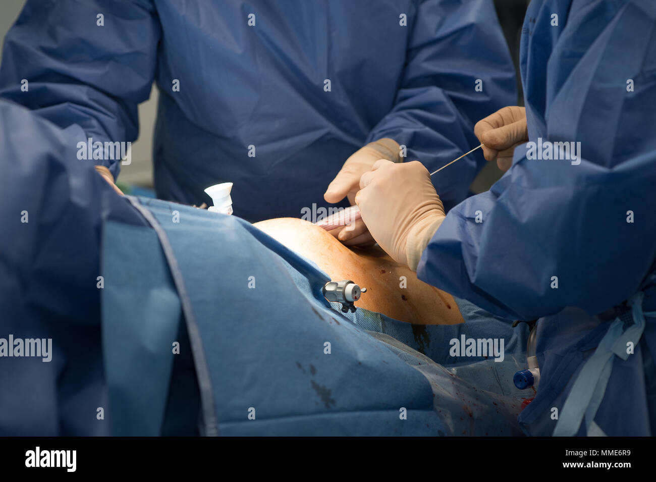 Endometriosis laparoscopy surgery hires stock photography and images