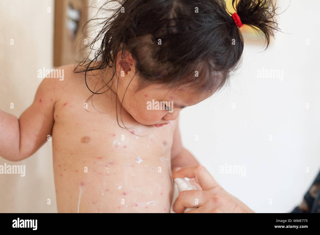 Chickenpox Stock Photos Chickenpox Stock Images Alamy