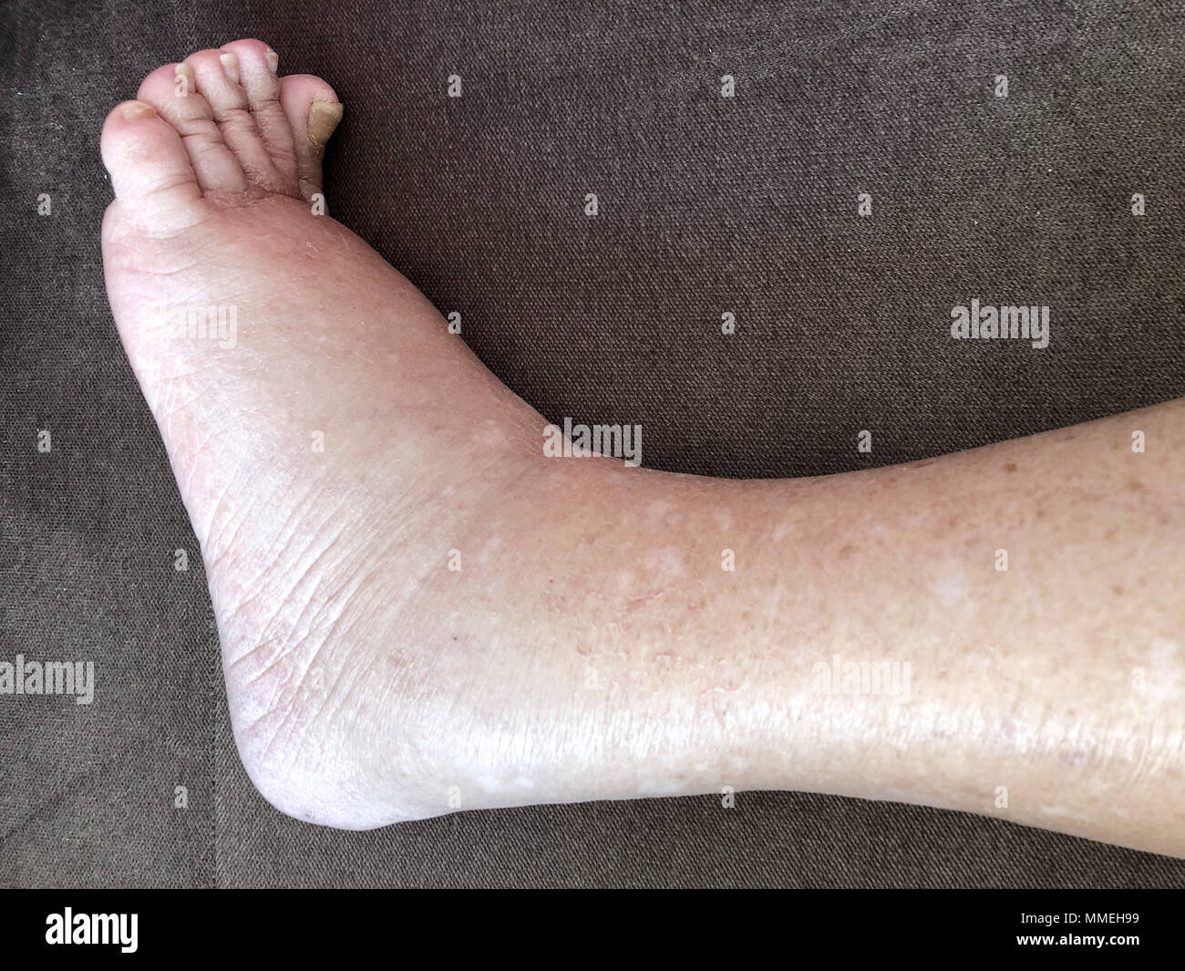 Closeup foot of diseased female patient who suffers from edema illness Stock Photo