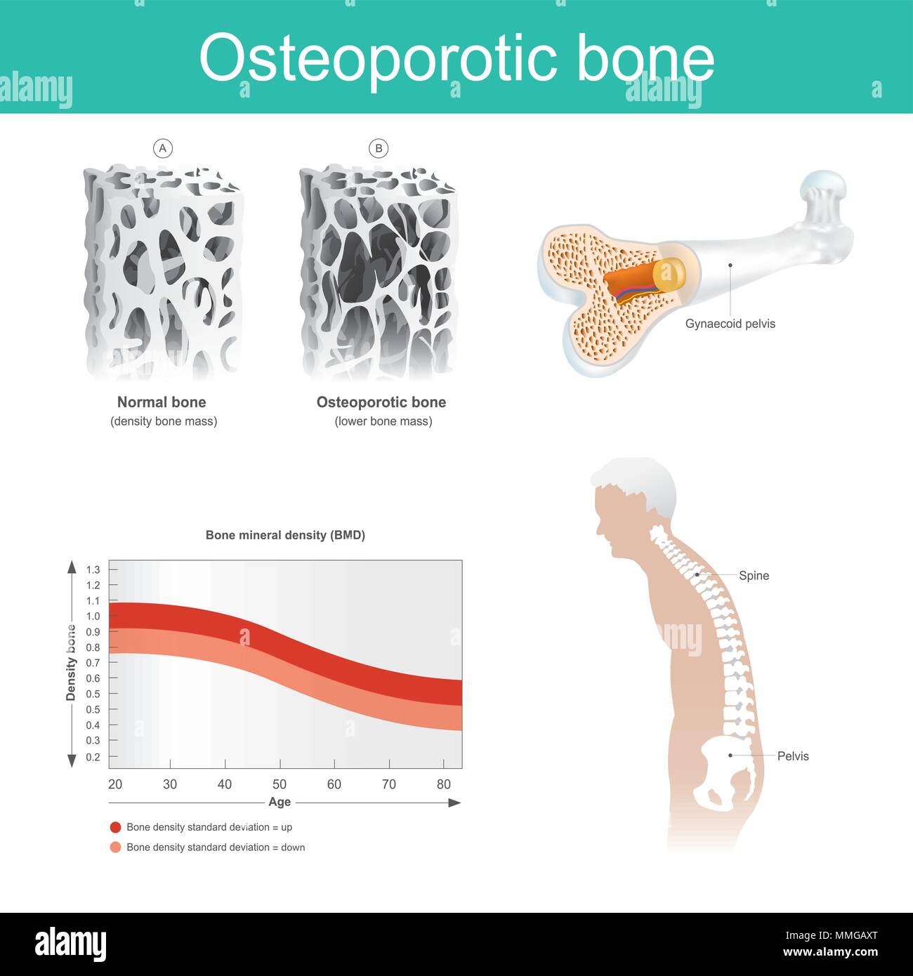 This is a disease in which the density and quality of bone are reduced. The old man's health deteriorated because from the lack of calcium. Stock Vector