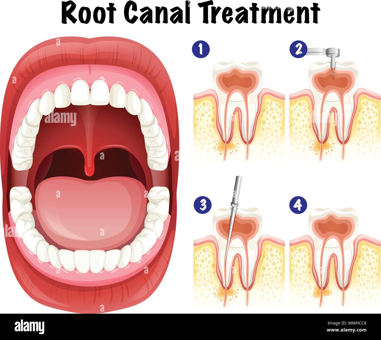 Dental Vector of Root Canal Treatment illustration Stock Vector Image & Art Alamy