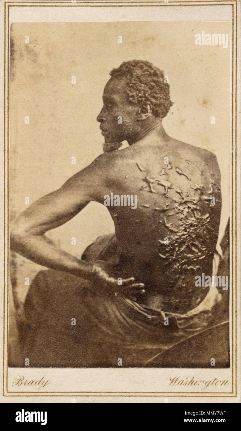 . Civil War CDV of Gordon (slave) at the Baton Rouge Union camp during his medical examination.  . March 1863. Photographers William D. McPherson and his partner Mr. Oliver, New Orleans; CDV by   Mathew Brady  (1822–1896)      Description American photographer, war photographer, photojournalist and journalist  Date of birth/death 18 May 1822 15 January 1896  Location of birth/death Warren County Manhattan  Work period from 1844 until circa 1887  Work location New York City, Washington, D.C.  Authority control  : Q187850 VIAF:?22965552 ISNI:?0000 0001 2209 4376 ULAN:?500126201 LCCN:?n81140569 N Stock Photo