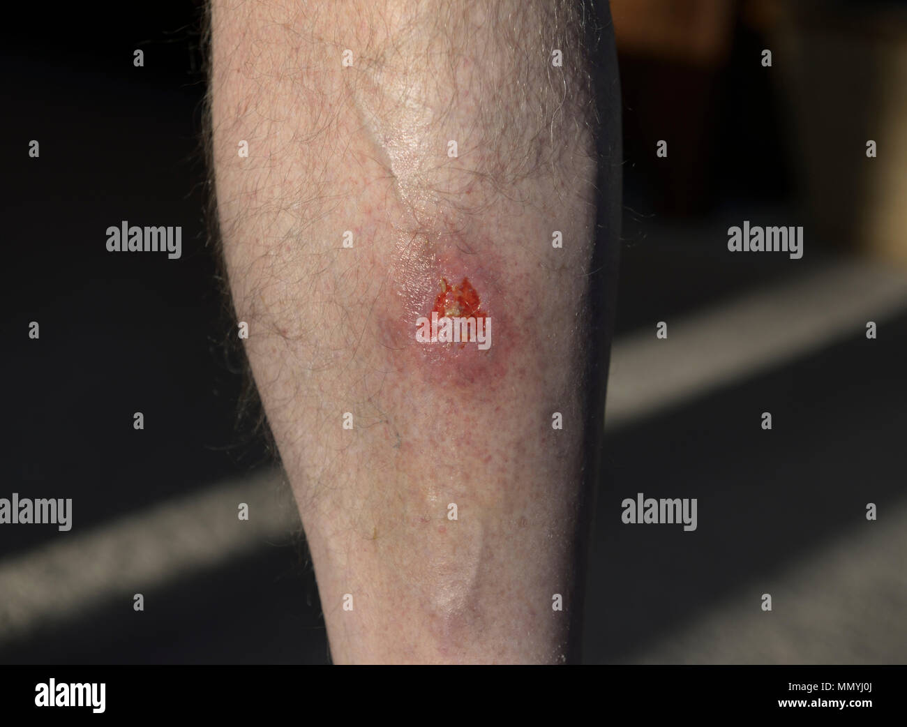 Open lower leg wound with cellulitis infection Stock Photo