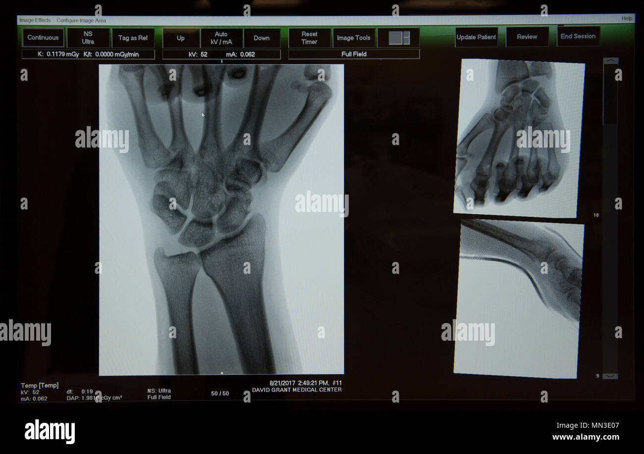 Image of the skeletal structure of a patient’s hand displayed on the monitor of a mobile X-ray machine, Aug. 22, 2017, at the Orthopedic Hand Clinic, David Grant U.S. Air Force Medical Center, Travis Air force Base. Calif.  DGMC's Orthopedic and Podiatry Clinics are comprised of dedicated and compassionate professionals who specialize in the comprehensive care of patients with bone and joint disorders of the extremities. (U.S. Air Force photo/ Heide Couch) Stock Photo
