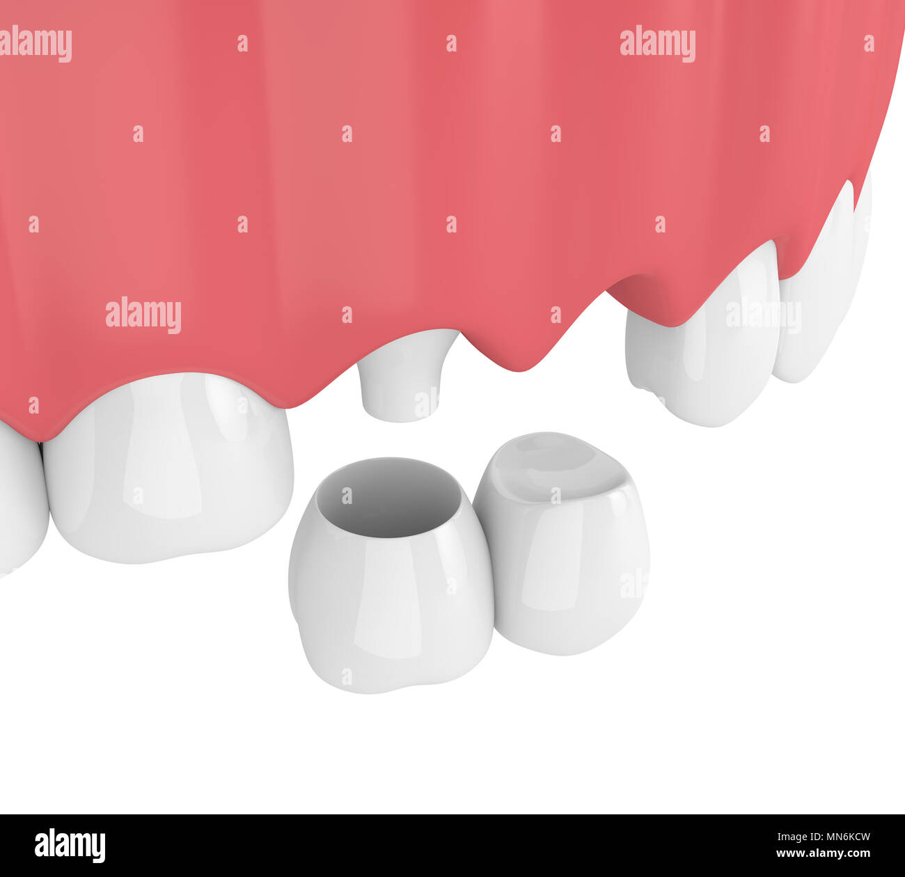3d render of dental cantilever bridge with crowns in upper jaw isolated