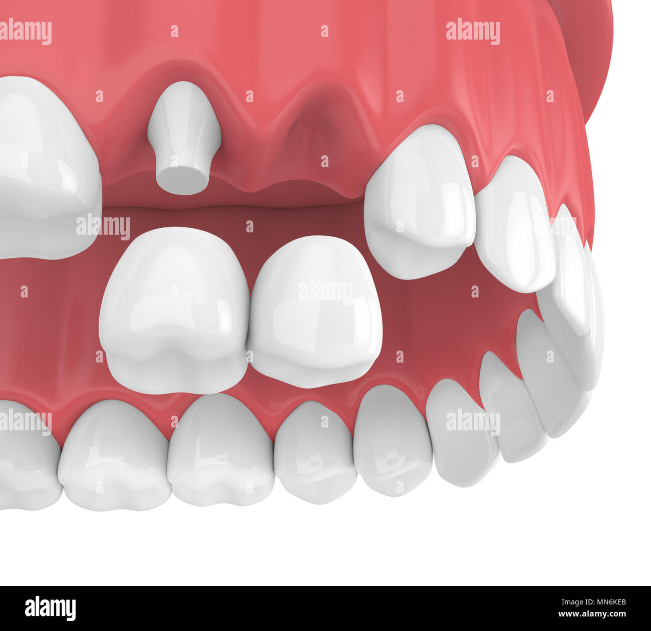3d render of dental cantilever bridge with crowns in upper jaw isolated