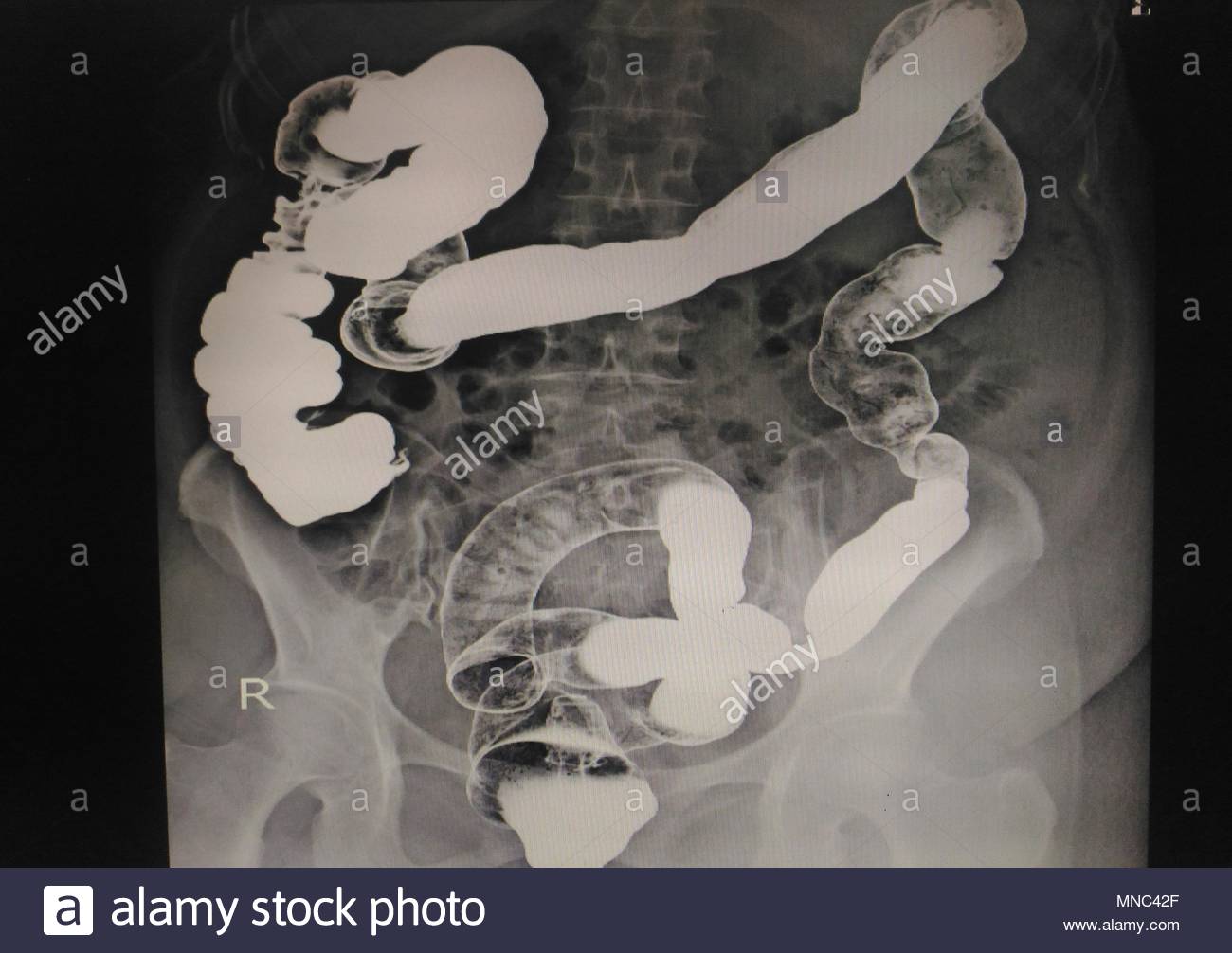 Bari Injection Gastrointestinal Tract Stock Photos & Gastrointestinal Tract Stock ...