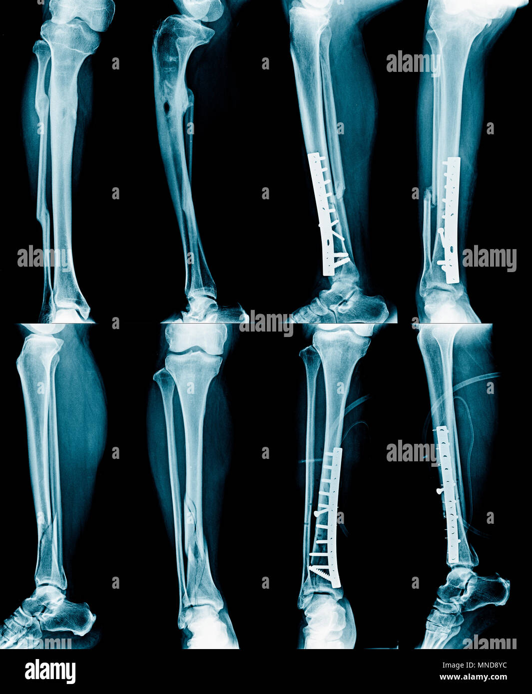 collection leg xray, fracture and leg fixed Stock Photo