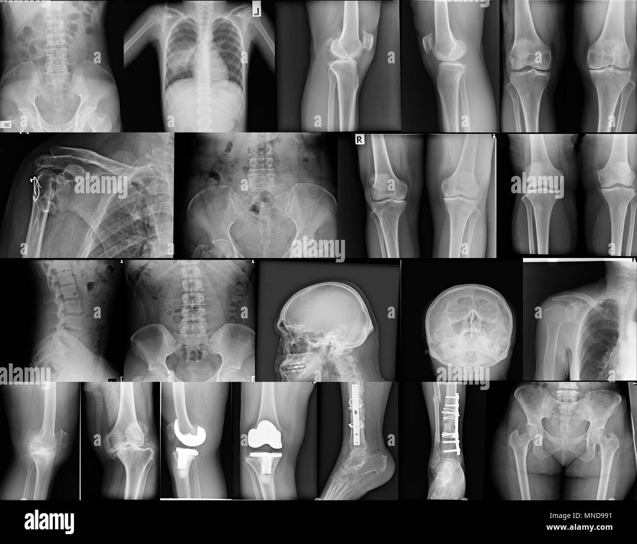 collection x-ray image knee, skull, chest, spine, pelvic, shoulder, fracture leg with fixation Stock Photo