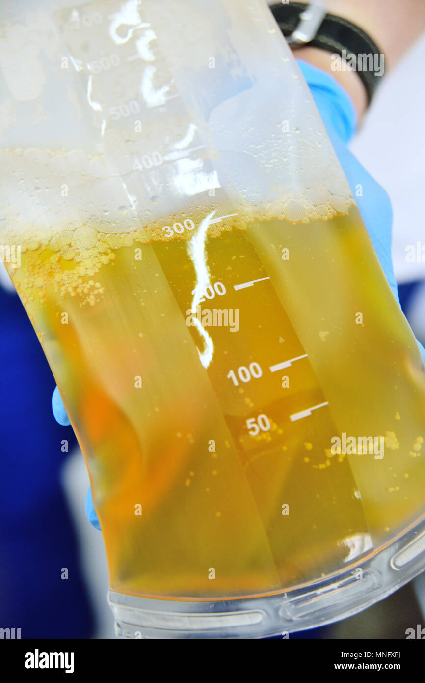 the procedure of purification of blood and plasma from toxins Stock ...