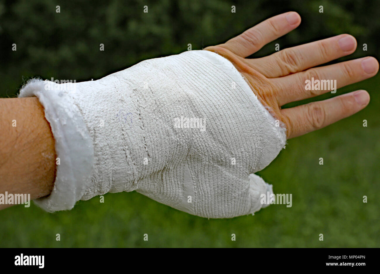 Plaster After Wrist Fracture High Resolution Stock Photography and ...