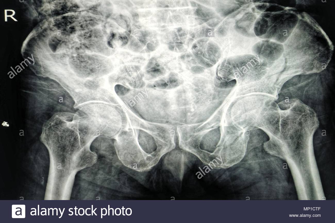 Pubic Bone Stock Photos & Pubic Bone Stock Images - Alamy