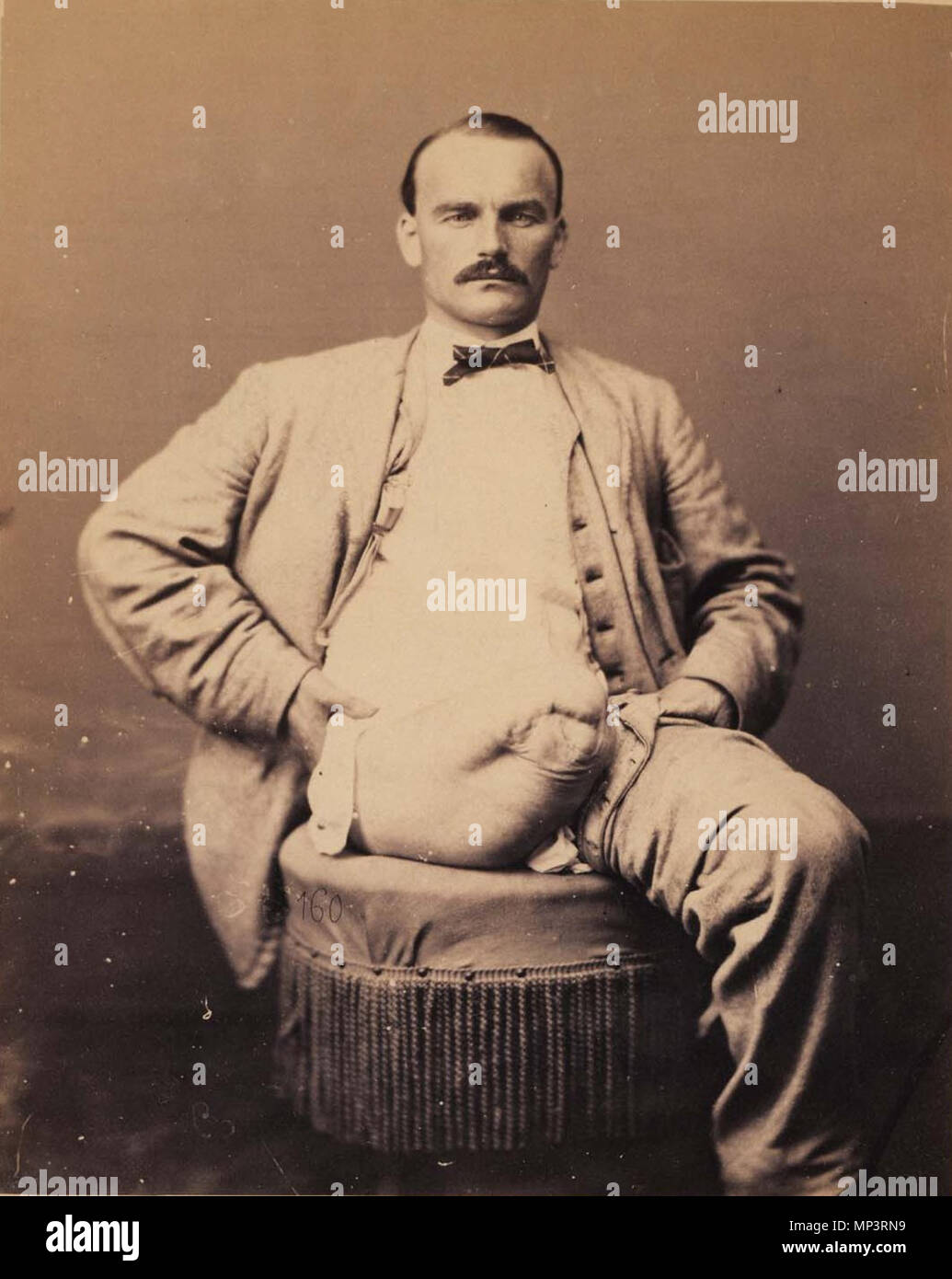 . English: Private Charles Myer, Amputation of the Right Thigh, a photograph by U.S. Army medical photographer William Bell (1830–1910) showing a leg amputee. 1865. William Bell (1830–1910) 1253 Wbell-leg-amputation Stock Photo