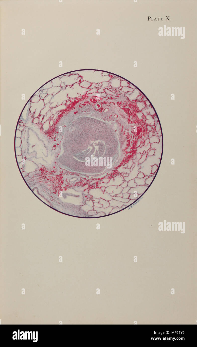 Plate X .  English: Plate X from An Atlas of Gas Poisoning by the American Red Cross and Medical Research Committee (American Red Cross, 1918). Plate title: 'Microscopic section of human lung from mustard gas poisoning, with death at end of second day (40 hours).' Text begins: 'The bronchiole is filled with fibrin and pus cells, and its lining epithelium has been completely destroyed. The inflammation has caused a characteristic ring of haemorrhage in the tissues around the bronchial tube, and infection is beginning to appear in the alveoli nearest to these inflamed tissues. But there is no ge Stock Photo