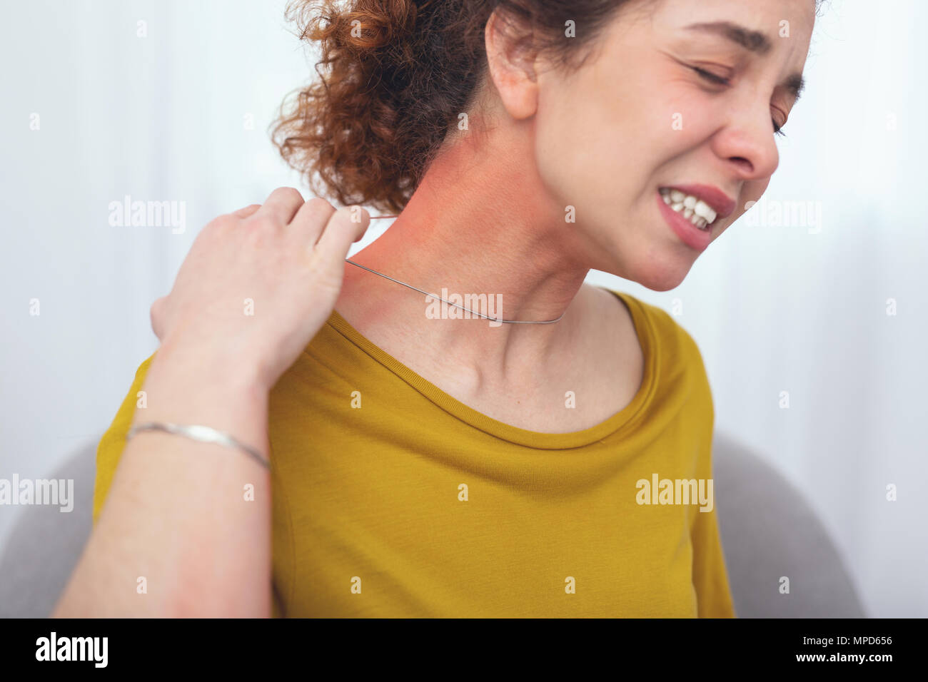 Young woman suffering from a skin rash Stock Photo Alamy