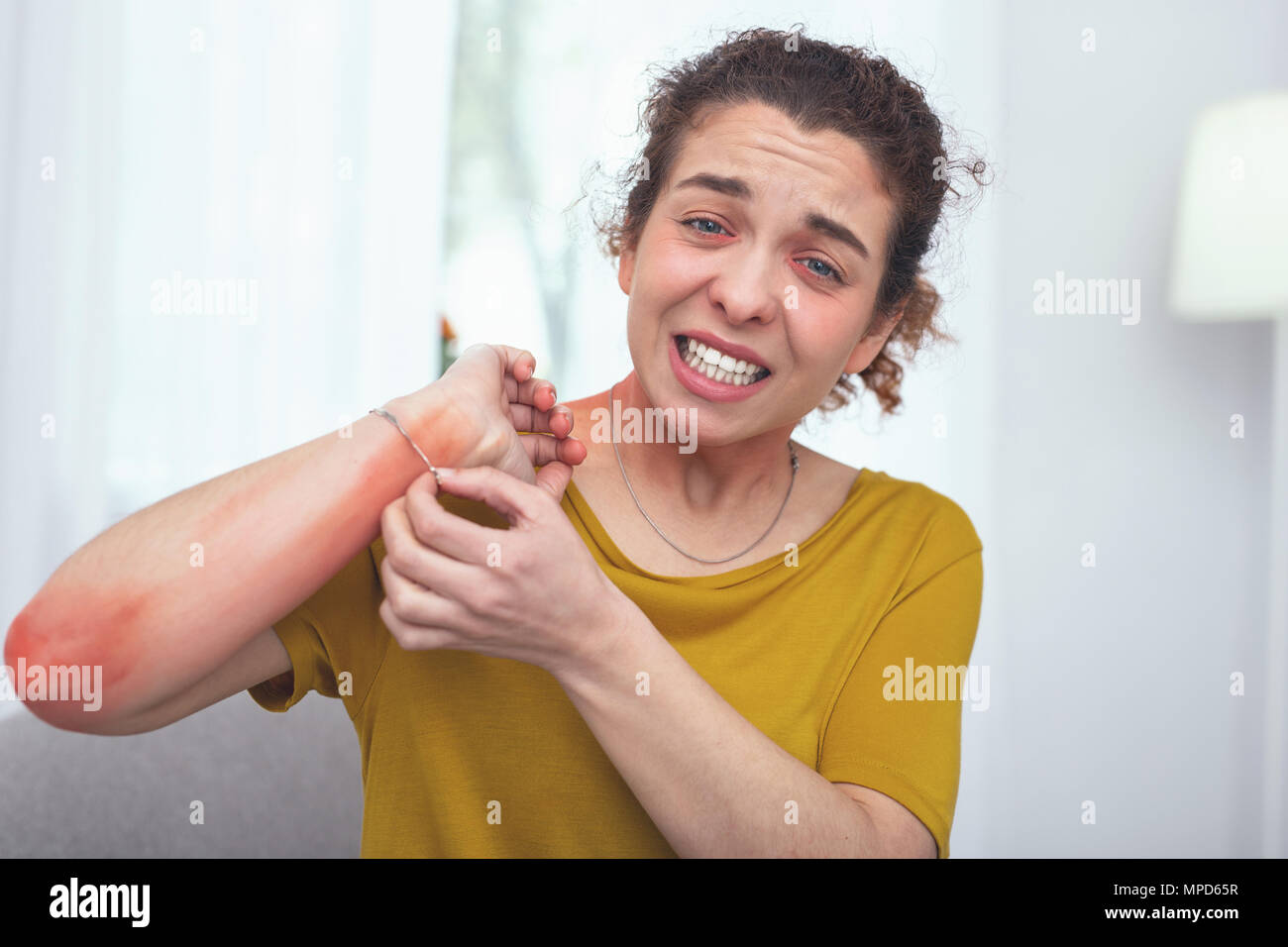 Young sick lady suffering from allergic rash Stock Photo