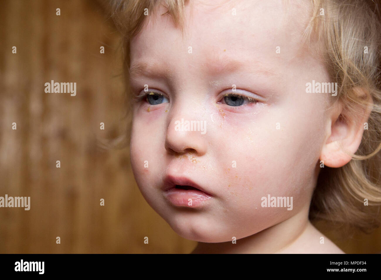 Little Boy With Blond Hair And Blue Eyes Suffering From Disease