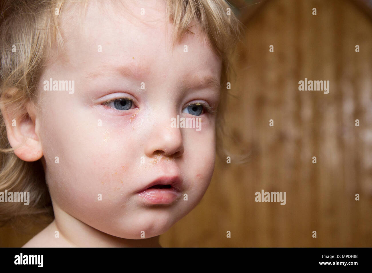 Swollen eyes face allergy hires stock photography and images Alamy
