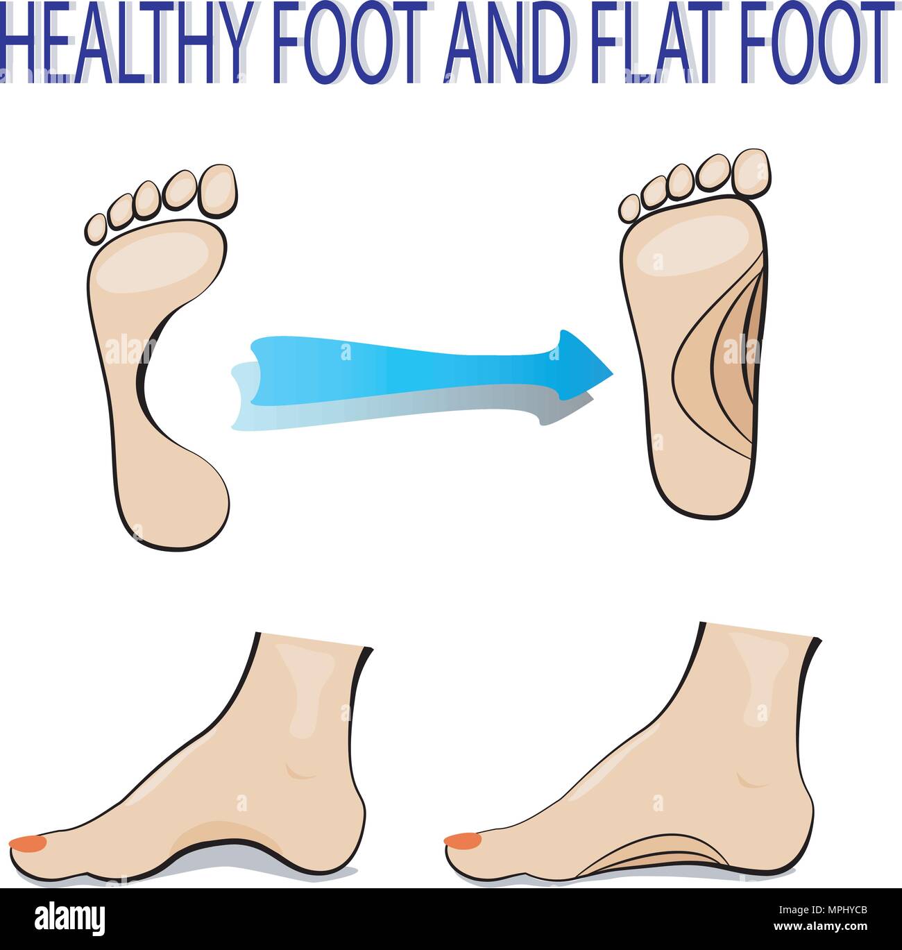 illustration of flat foot and healthy foot Stock Vector