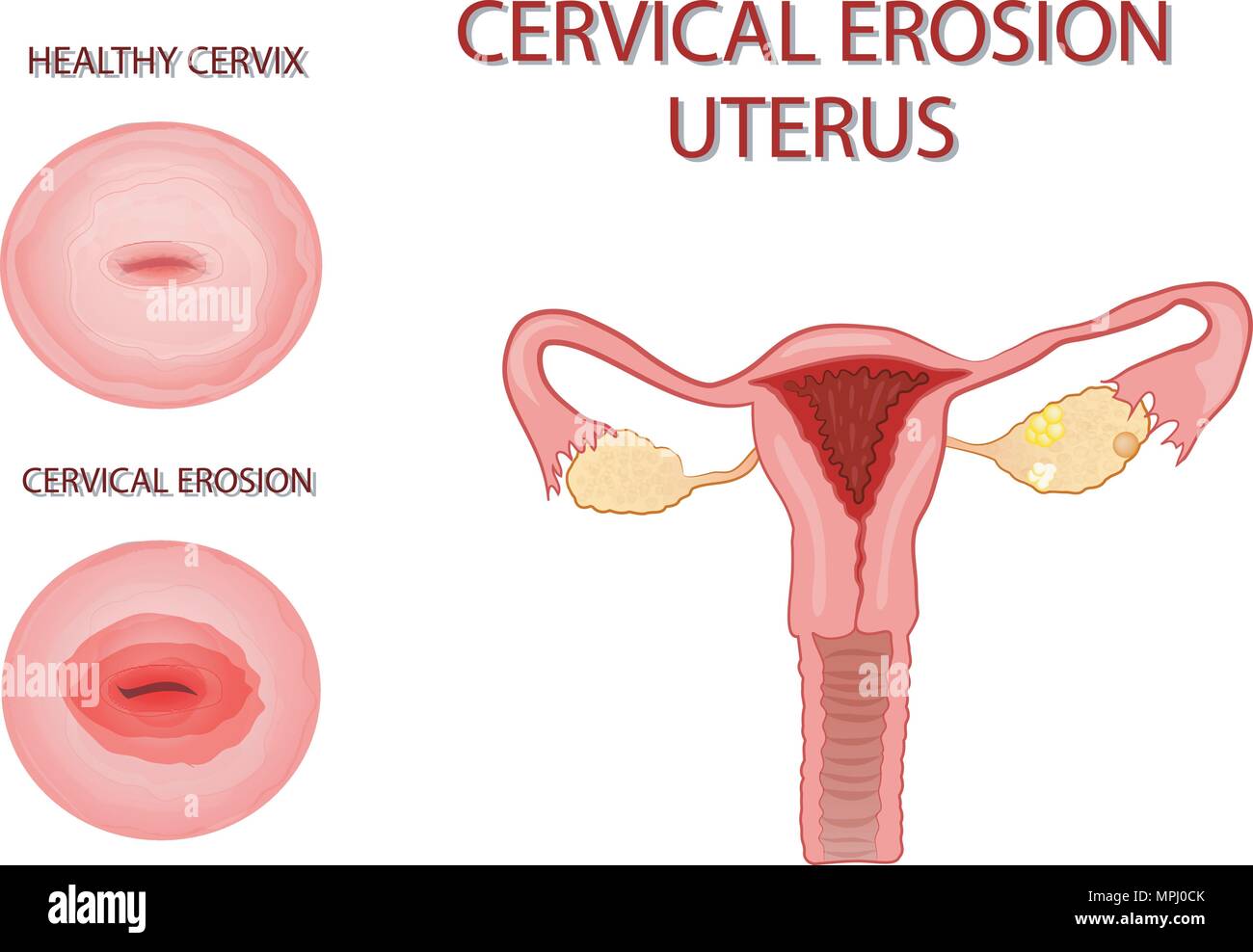 illustration of the uterus. cervical erosion Stock Vector