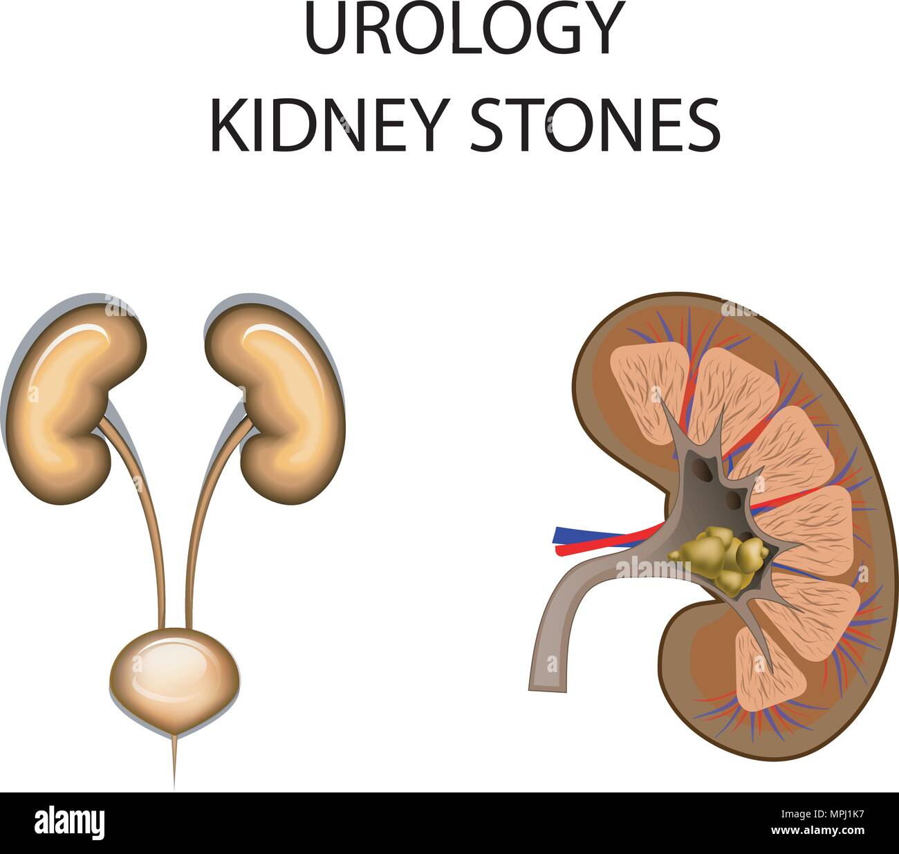illustration of the kidney stones. urology, dialysis Stock Vector Image