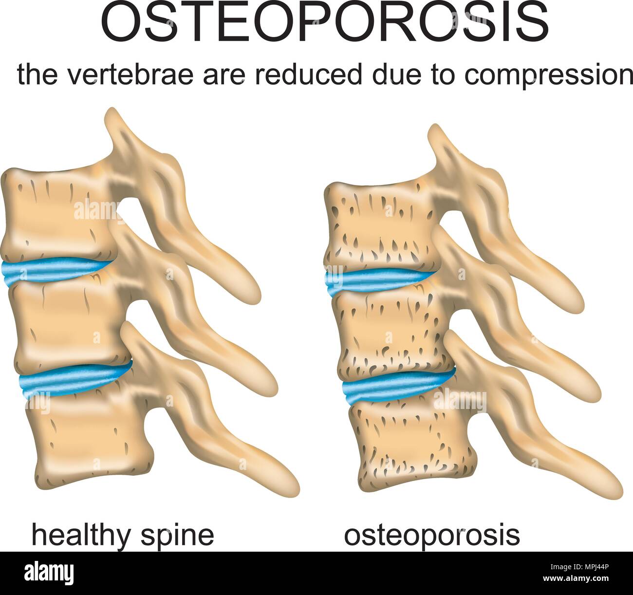 Healthy spine hi-res stock photography and images - Alamy