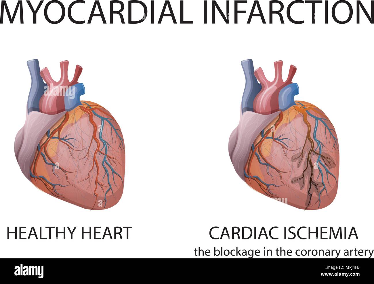 illustration of a healthy human heart, and heart attacks Stock Vector