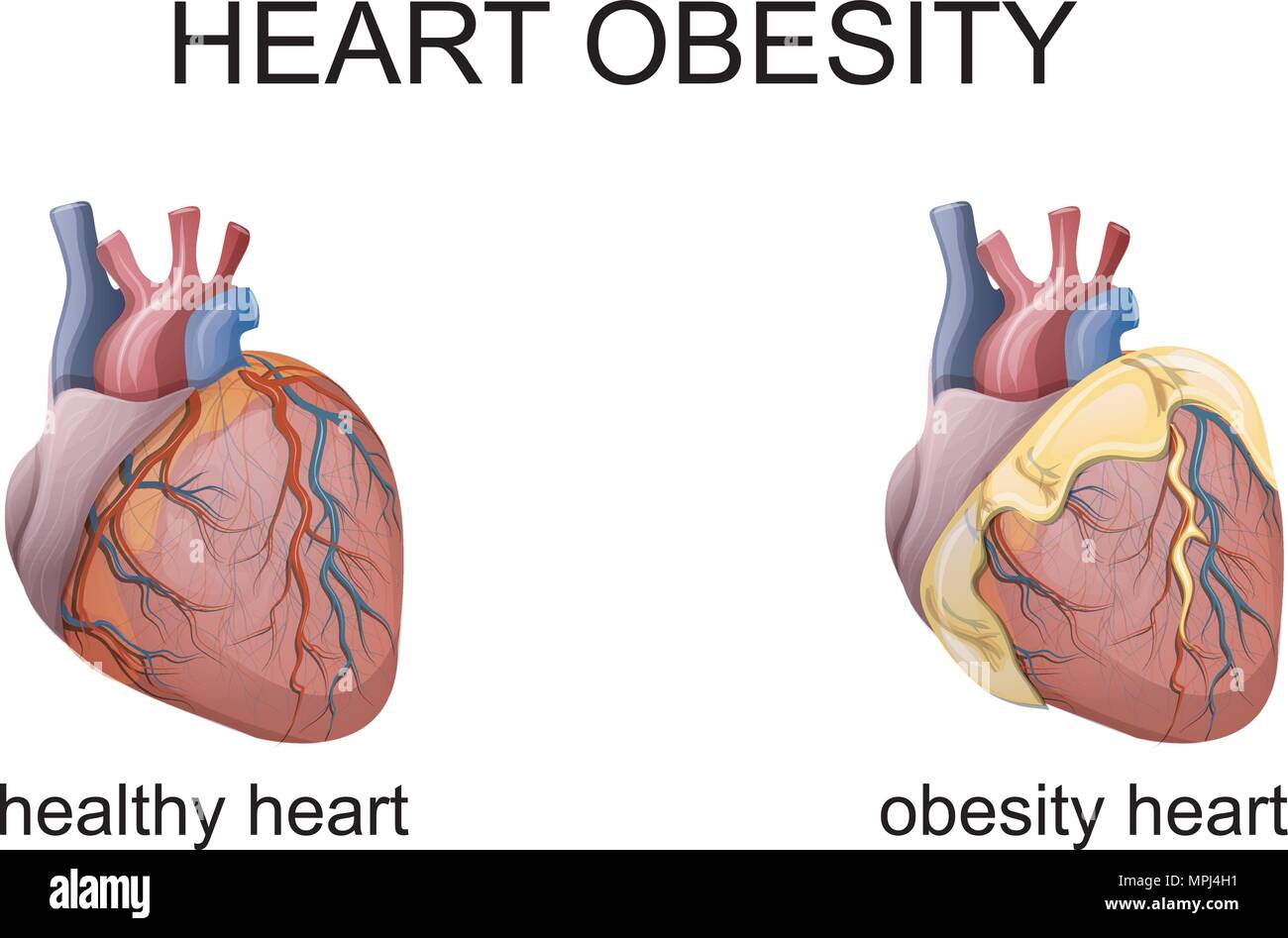 Ожирение и сердечно сосудистые заболевания. Здоровое и больное сердце. Сердце здорового человека и с ожирением.