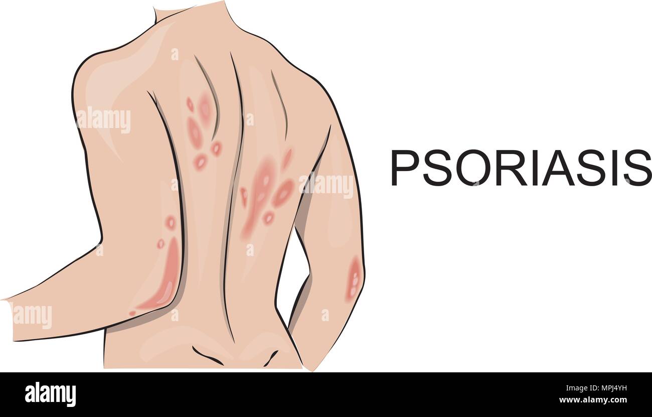 illustration of the human body, psoriatic rash. Dermatology. Allergic reaction, vector. Stock Vector