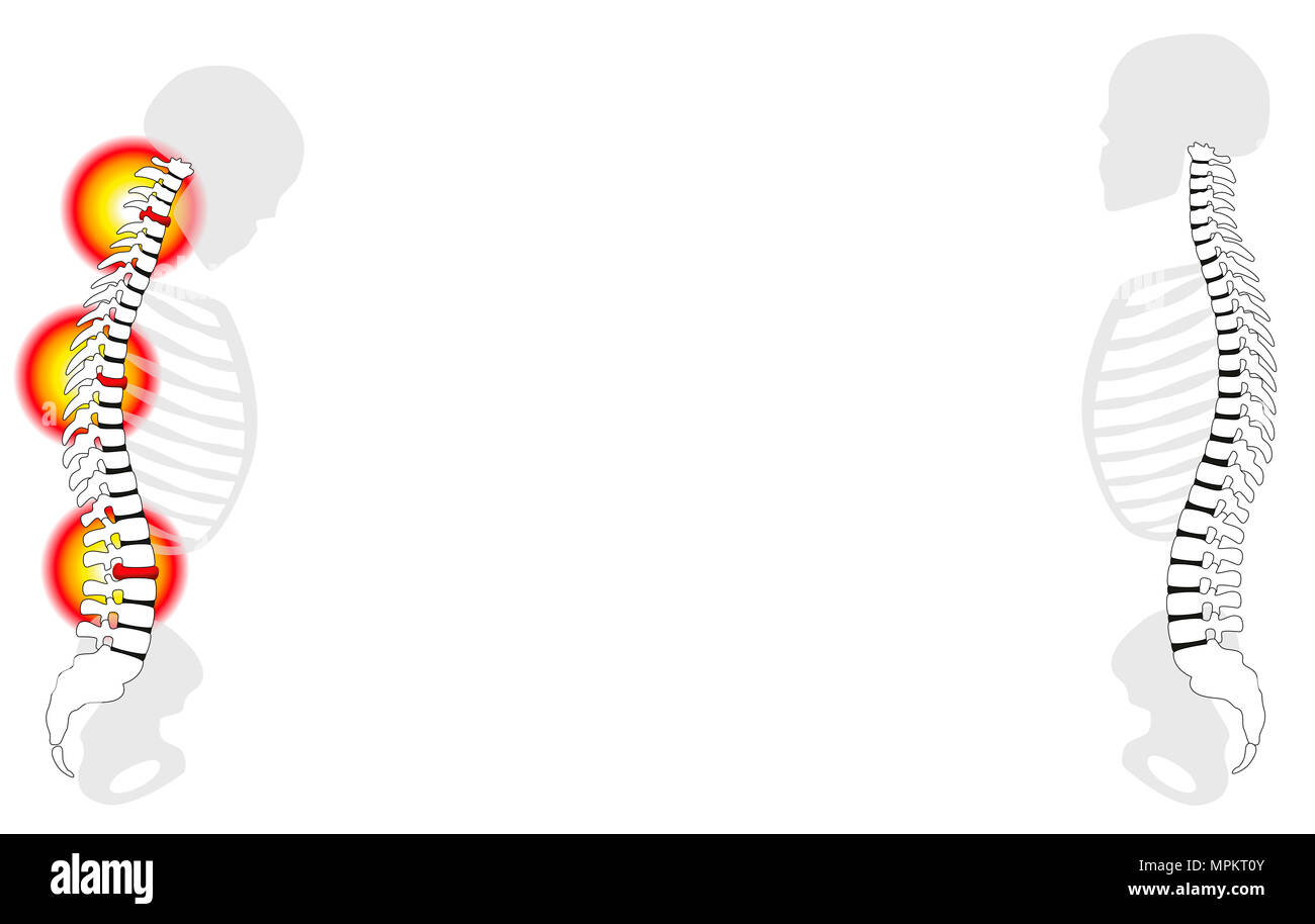 Spinal disc herniation hi-res stock photography and images - Alamy