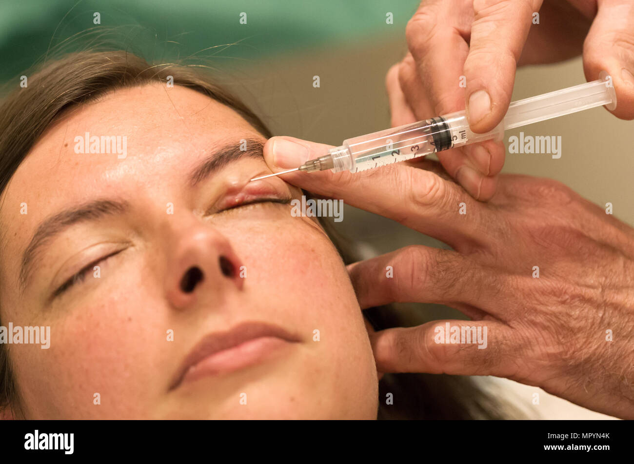 Blepharitis Operation