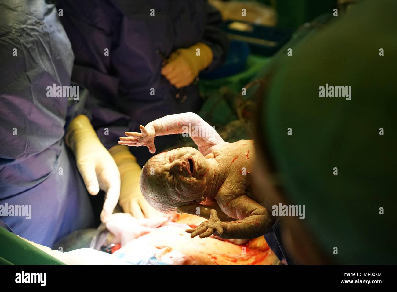 Baby being born by Caesarean section in hospital, covered in vernix, umbilical cord still attached and mother’s surgical wound in background Stock Photo
