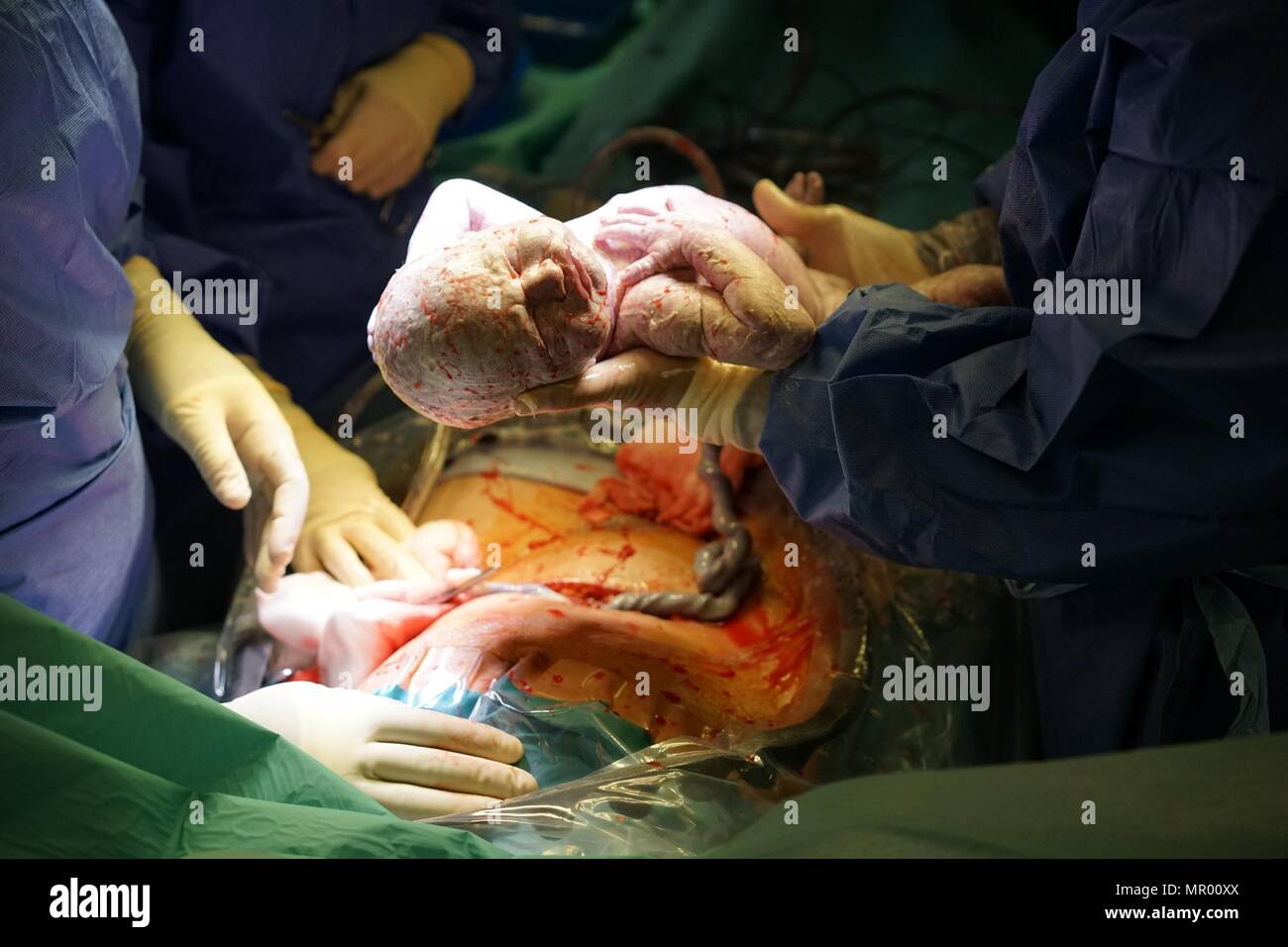 Baby being born by Caesarean section in hospital, covered in vernix, umbilical cord still attached and mother’s surgical wound in background Stock Photo