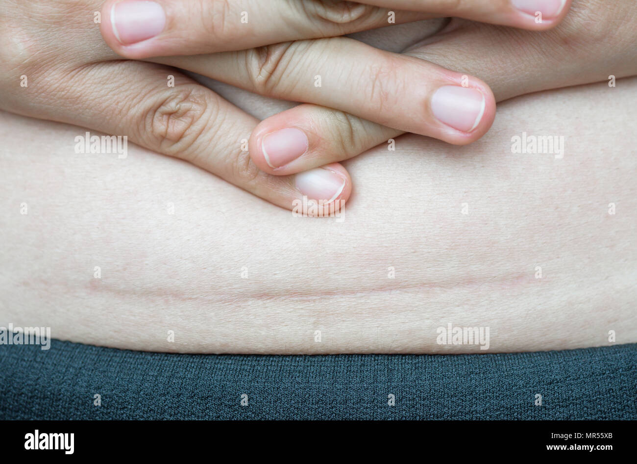 Belly after c section hires stock photography and images Alamy