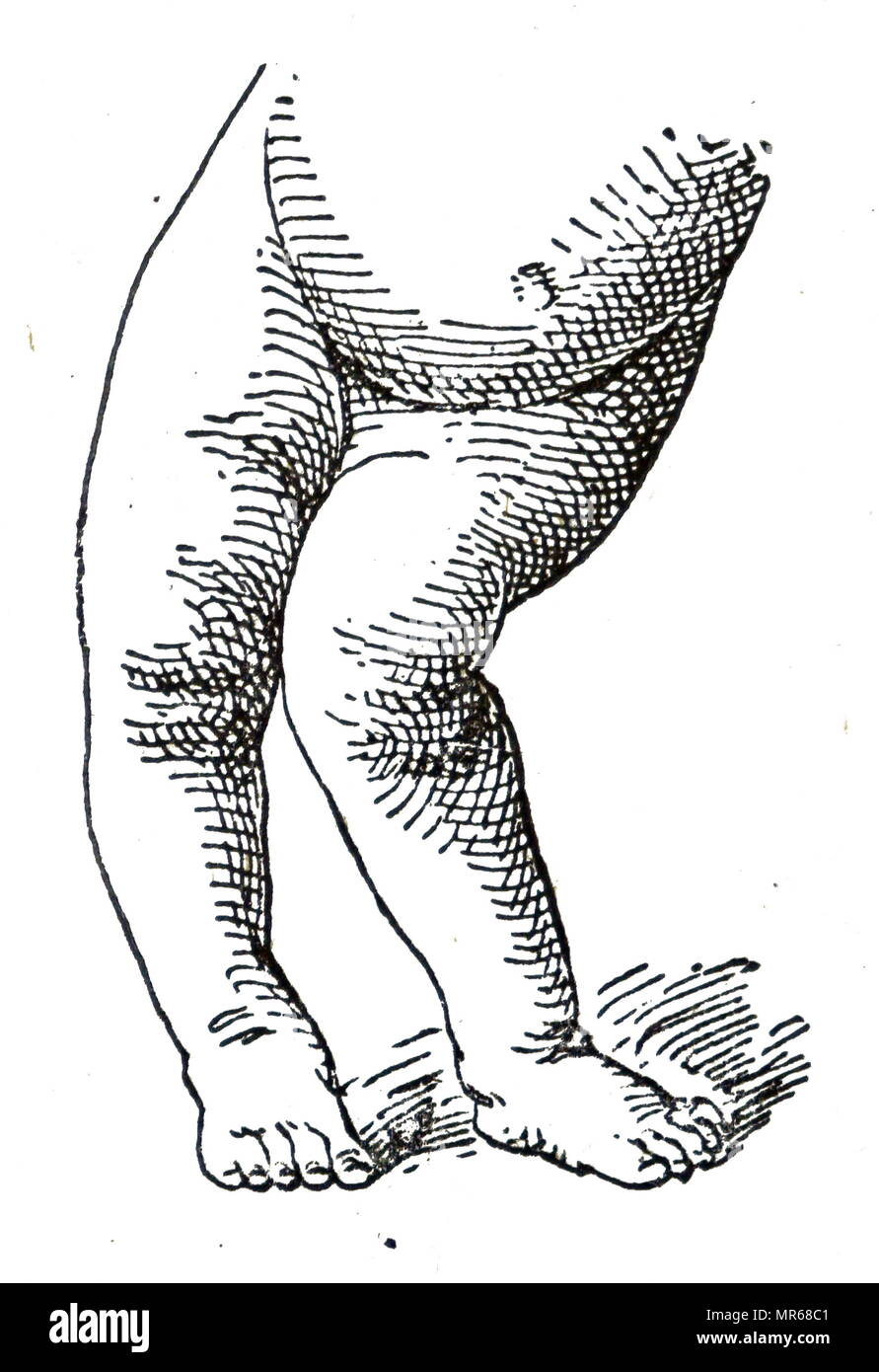 Illustration depicting the affects of Rickets of a boy aged 3, showing shortening and distortion of legs and position of the abdomen.  Rickets is defective mineralisation or calcification of bones before epiphyseal closure in immature mammals due to deficiency or impaired metabolism of vitamin D, phosphorus or calcium, potentially leading to fractures and deformity. Dated 20th century Stock Photo