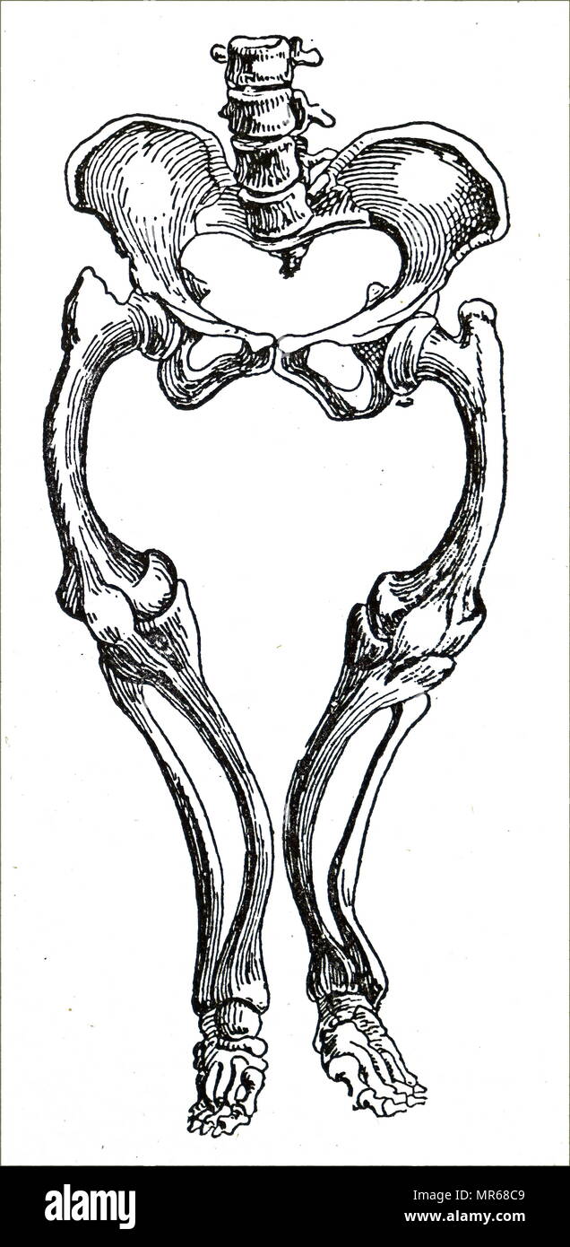 Engraving depicting part of a male skeleton showing the effects of Rickets on the leg bones. Rickets is defective mineralisation or calcification of bones before epiphyseal closure in immature mammals due to deficiency or impaired metabolism of vitamin D, phosphorus or calcium, potentially leading to fractures and deformity. Dated 20th century Stock Photo