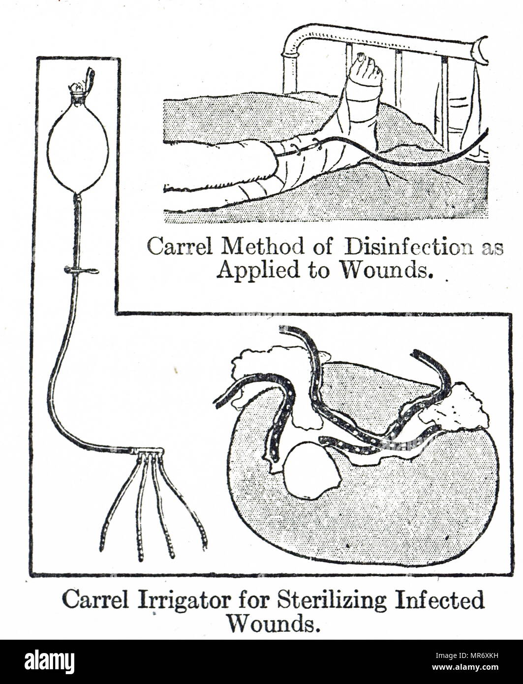 Method of sterilising wounds using Dakin's sodium hypochlorite 0.05 per cent, devised by Dr Alexis Carrel of the Rockefeller Institute. Left and bottom, irrigator and sectional view of wound: right top, device applied to a leg wound. Dated 20th century Stock Photo