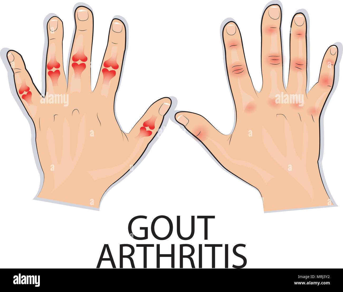 the mechanism of development of gout. pain in the joints Stock Vector