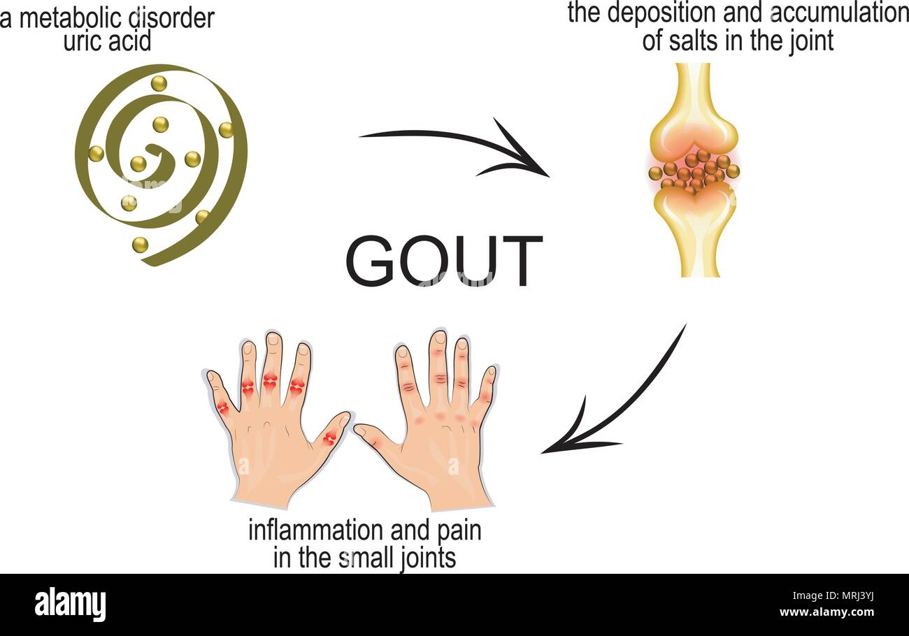 the mechanism of development of gout. pain in the joints Stock Vector