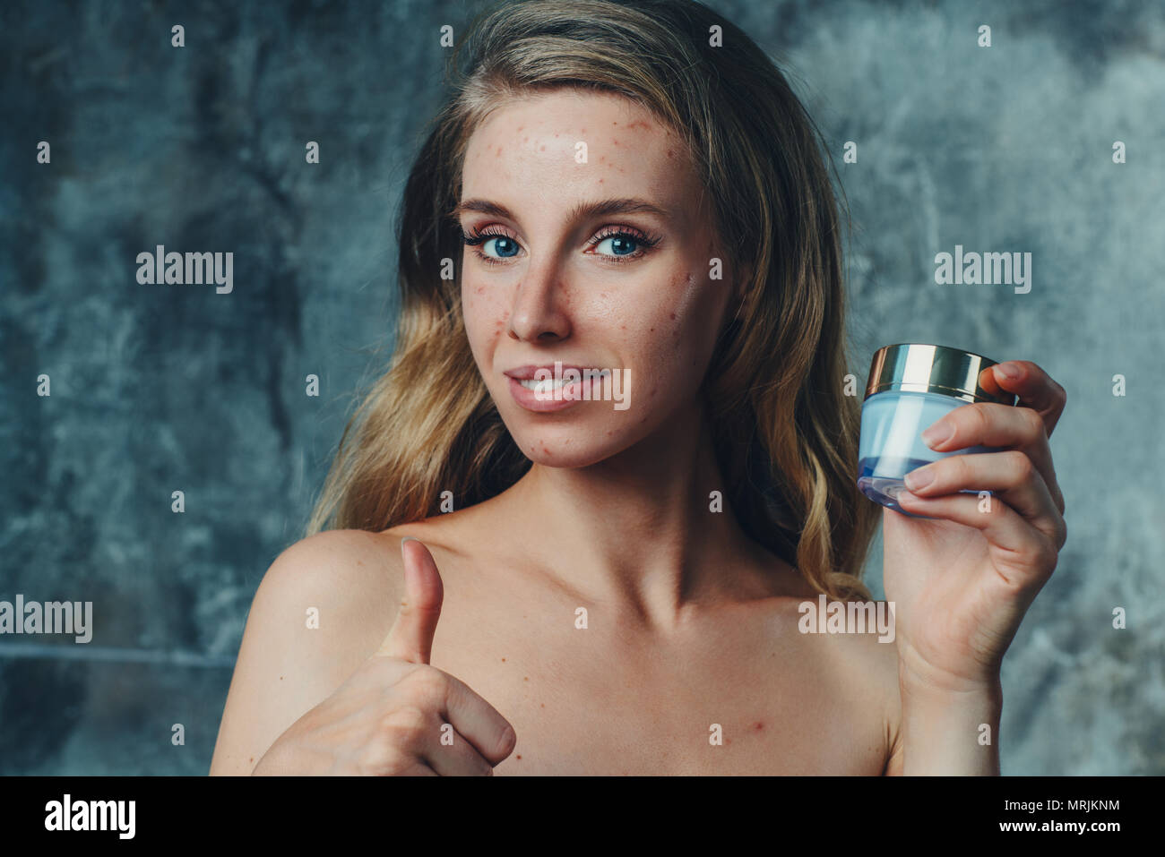 Young woman have allergy and acne on face. She is using new cream to solve this problem. Stock Photo