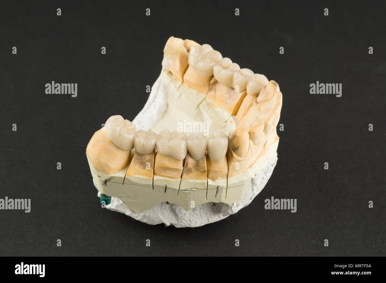 artificial dental structures made of ceramics for restoration of