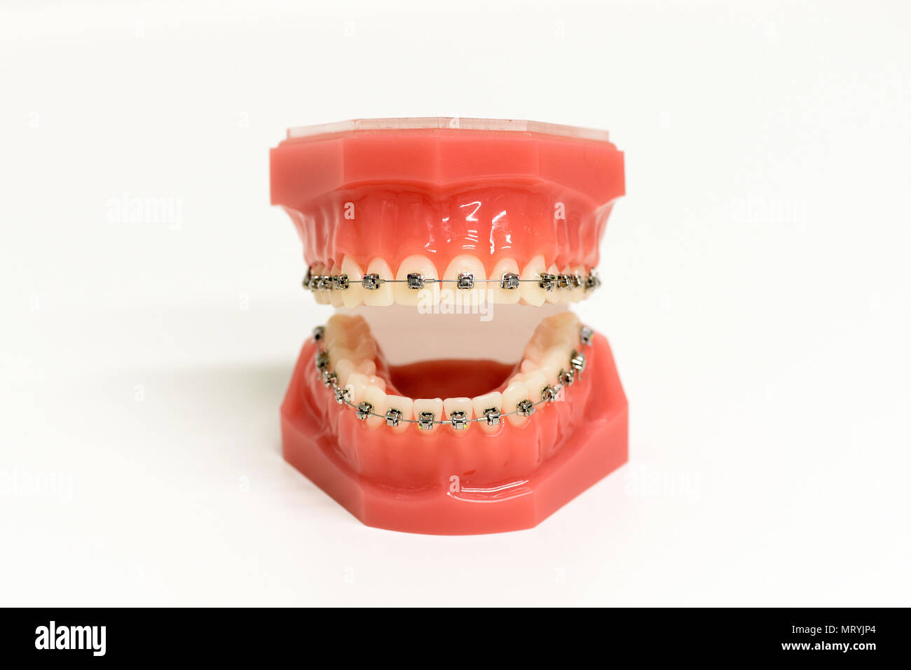 Orthodontic model of teeth with attached metal braces to straighten and align the teeth or correct the bite, open frontal view Stock Photo