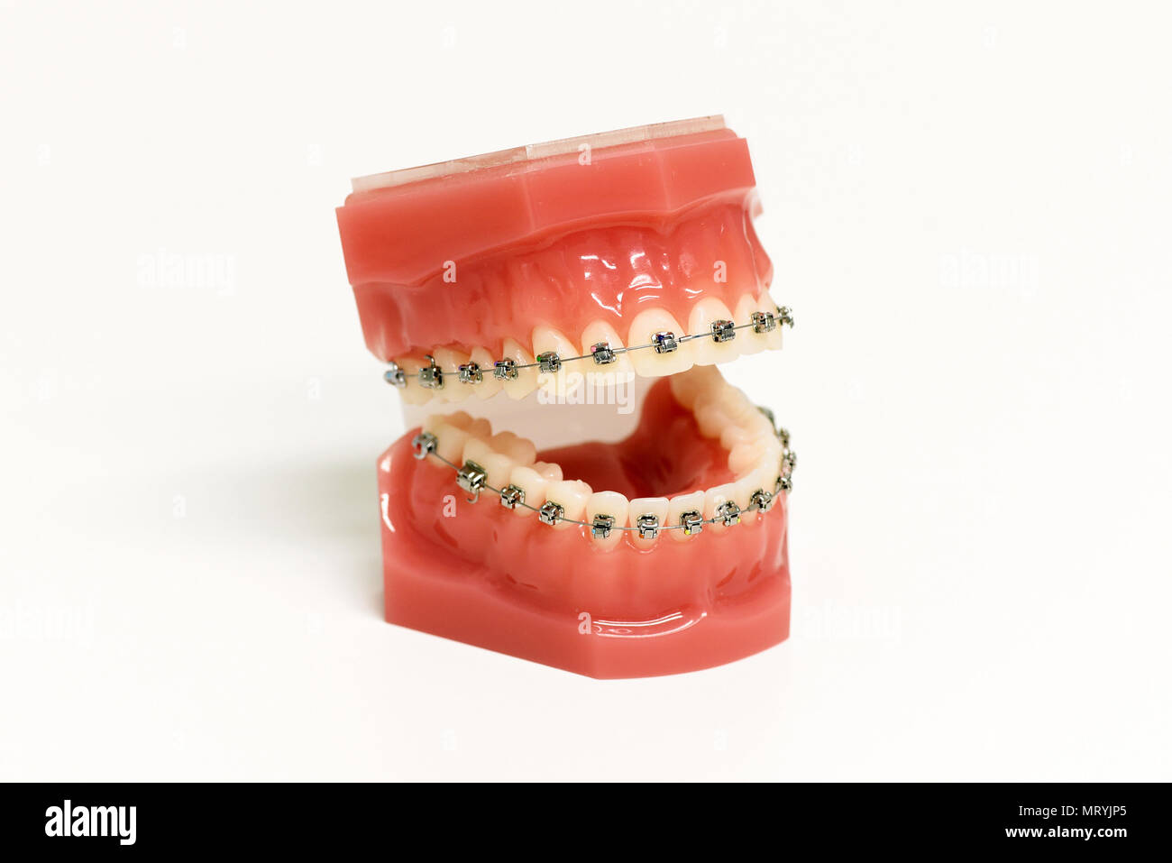Dental model with orthodontic appliance showing metal braces attached to the upper and lower teeth to correct the bite by straightening and aligning t Stock Photo