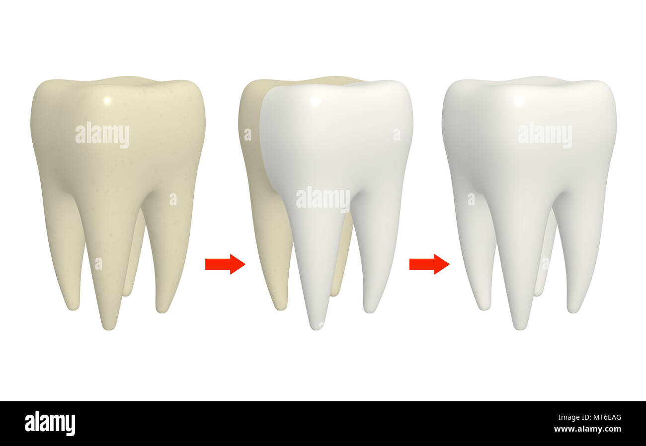 Cleaning tooth process. Human tooth with different enamel color