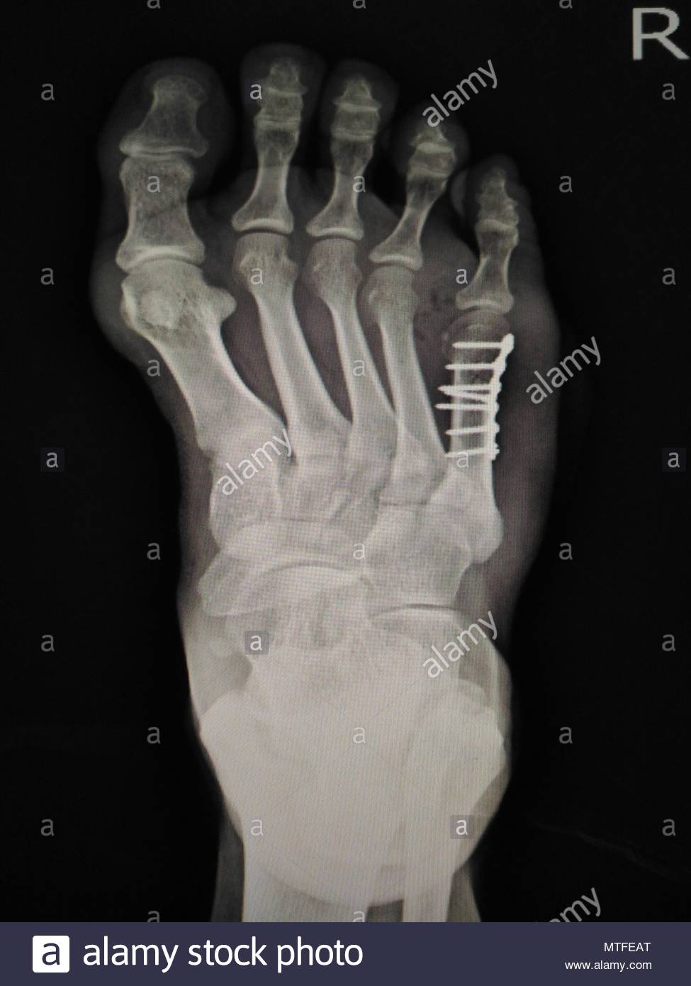 Fixation Of Ankle Stock Photos & Fixation Of Ankle Stock Images Alamy