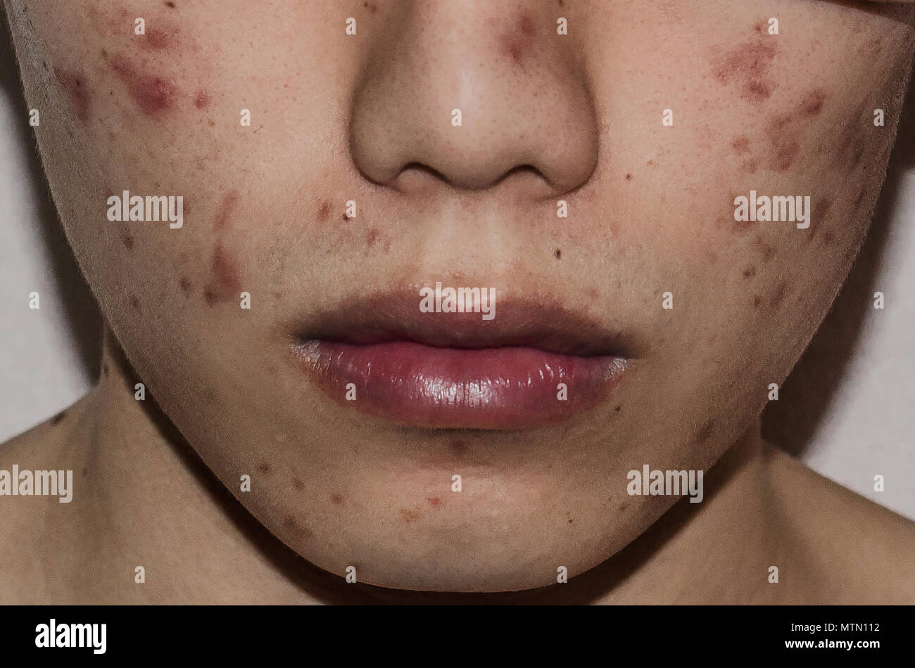 Close up of Acne on the skin, Acne on the face caused by Hormone, Acne inflammation and Wrinkle on the face skin Stock Photo